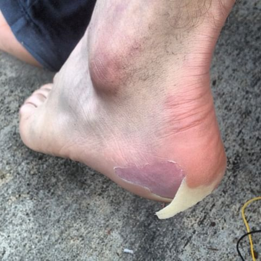 Bruised heel from best sale running