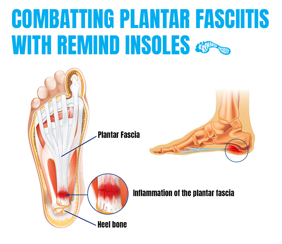 Combatting Plantar Fasciitis With Remind Insoles